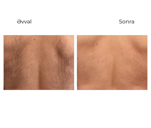 Candela GentleMax Pro Plus